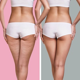 Целлюлит на ногах