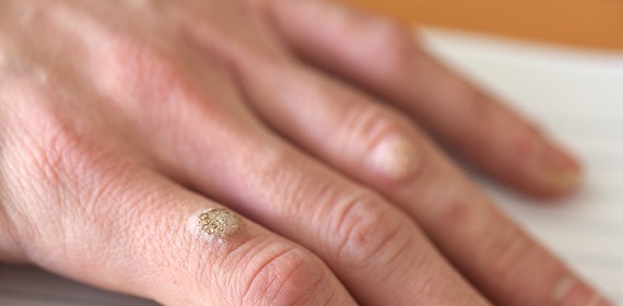 Бородавки на руках